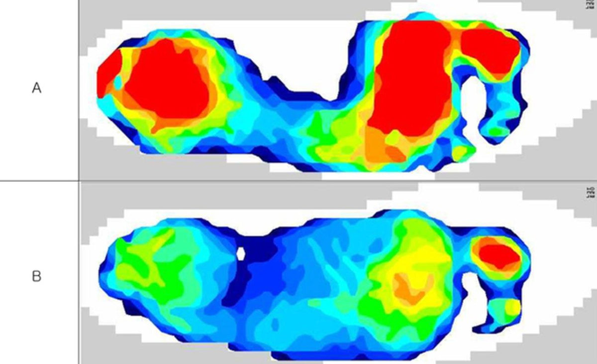 Pressure map comparison: conventional shoe (A) vs PIPU (B)